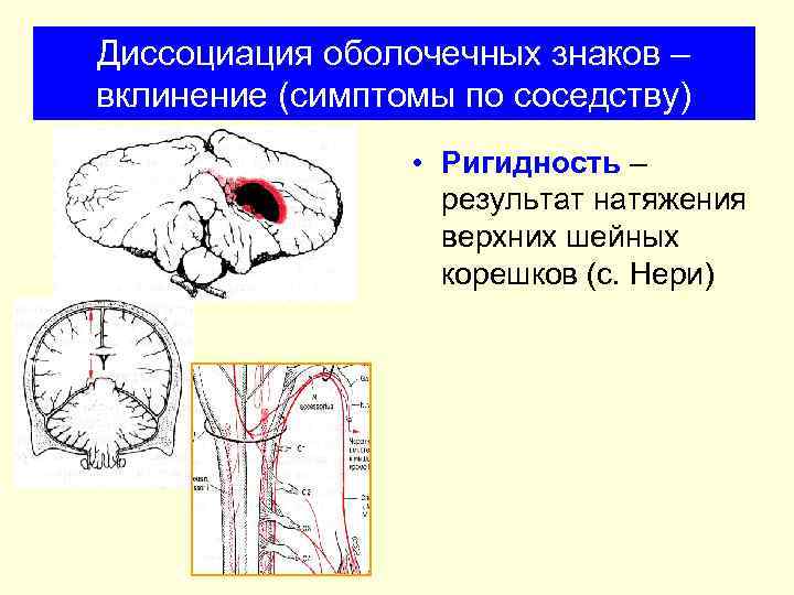 Диссоциация оболочечных знаков – вклинение (симптомы по соседству) • Ригидность – результат натяжения верхних