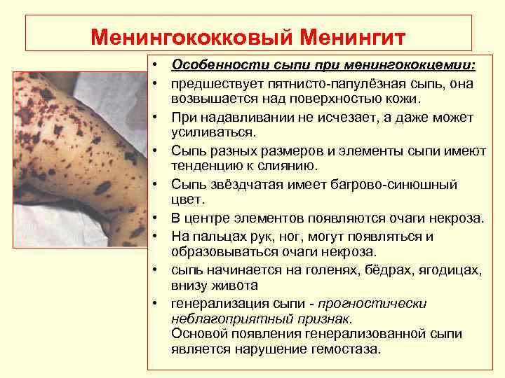 Менингококковый Менингит • Особенности сыпи при менингококцемии: • предшествует пятнисто папулёзная сыпь, она возвышается