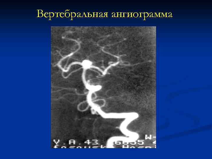 Вертебральная ангиограмма 