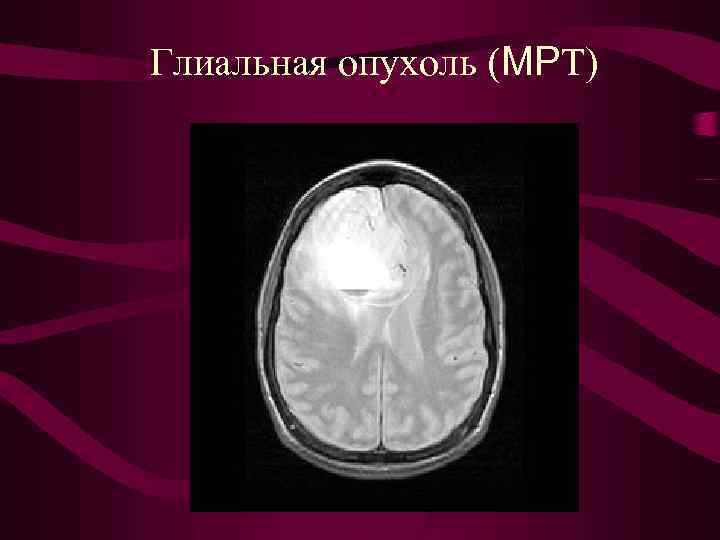 Глиальная опухоль (МРТ) 