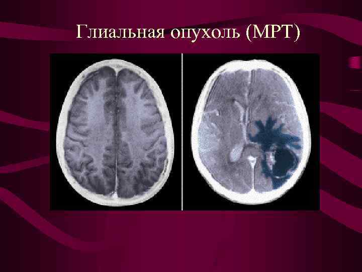 Глиальная опухоль (МРТ) 