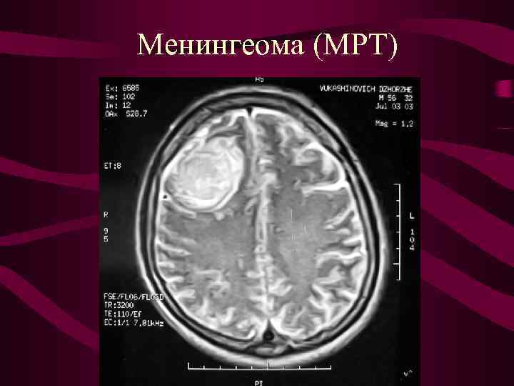 Менингеома (МРТ) 