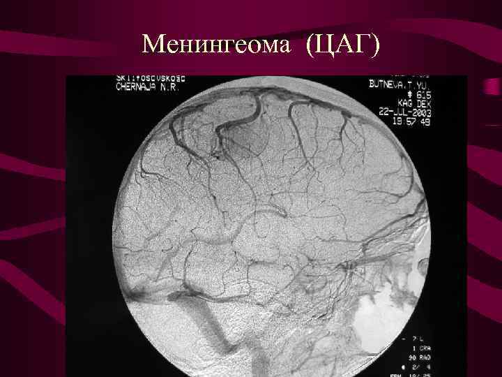 Менингеома (ЦАГ) 