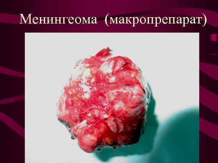 Менингеома (макропрепарат) 