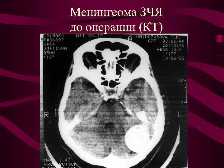 Менингеома ЗЧЯ до операции (КТ) 