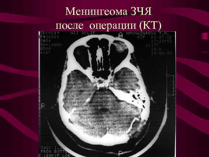 Менингеома ЗЧЯ после операции (КТ) 