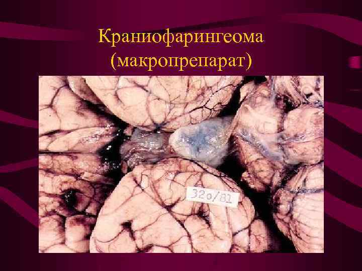 Краниофарингеома (макропрепарат) 