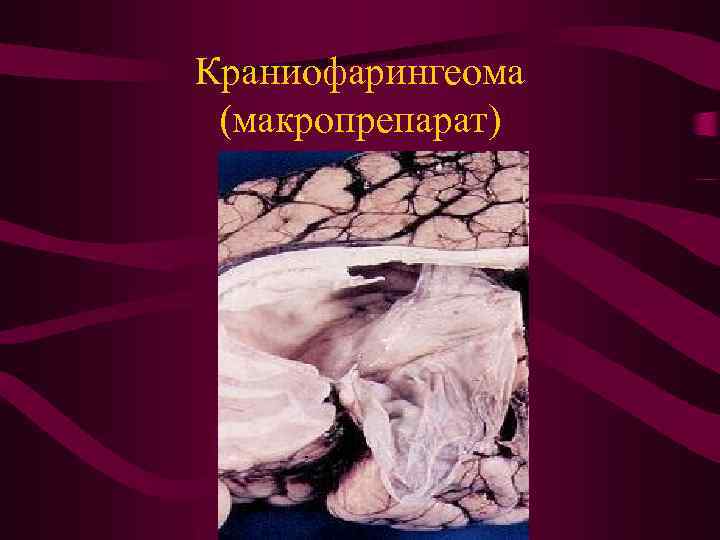 Краниофарингеома (макропрепарат) 
