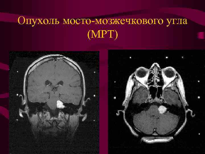 Опухоль мосто-мозжечкового угла (МРТ) 