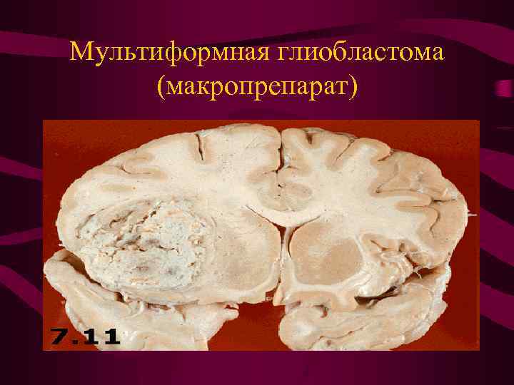 Мультиформная глиобластома (макропрепарат) 
