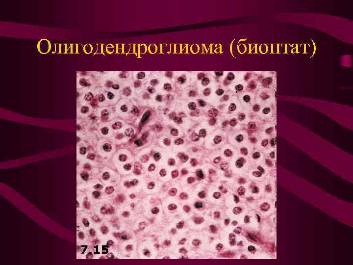 Олигодендроглиома (биоптат) 