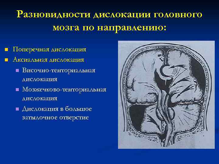 Срединные структуры. Латеральная дислокация головного мозга. Височно-тенториальное дислокация височно-тенториальная. Аксиальный дислокационный синдром. Синдром дислокации мозговых структур.