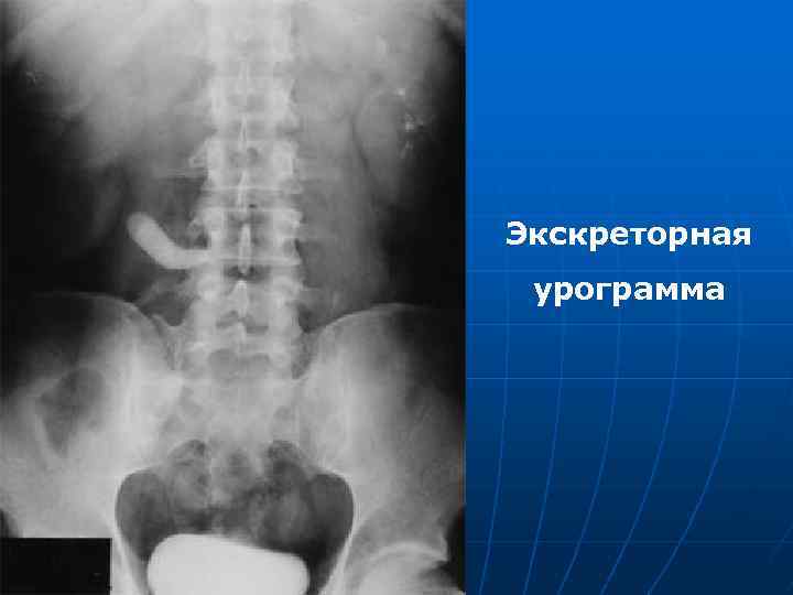 Экскреторная урограмма 