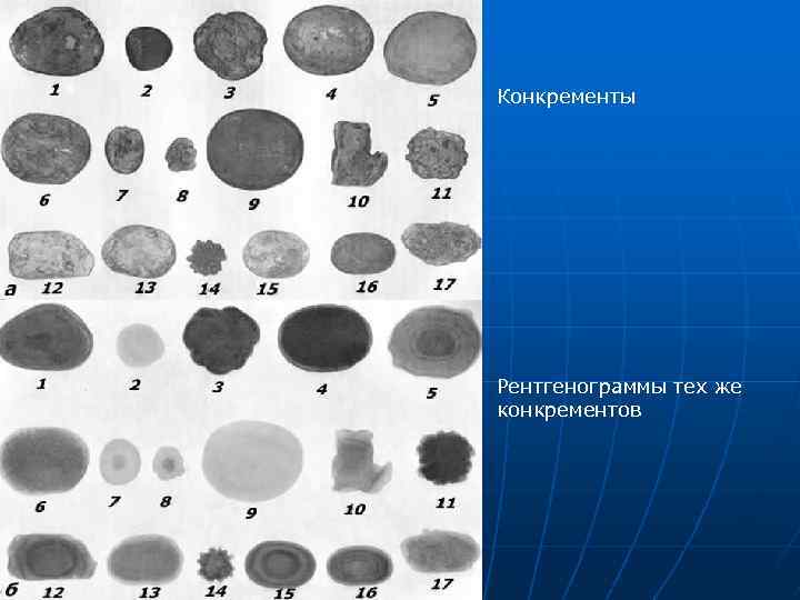 Конкременты Рентгенограммы тех же конкрементов 
