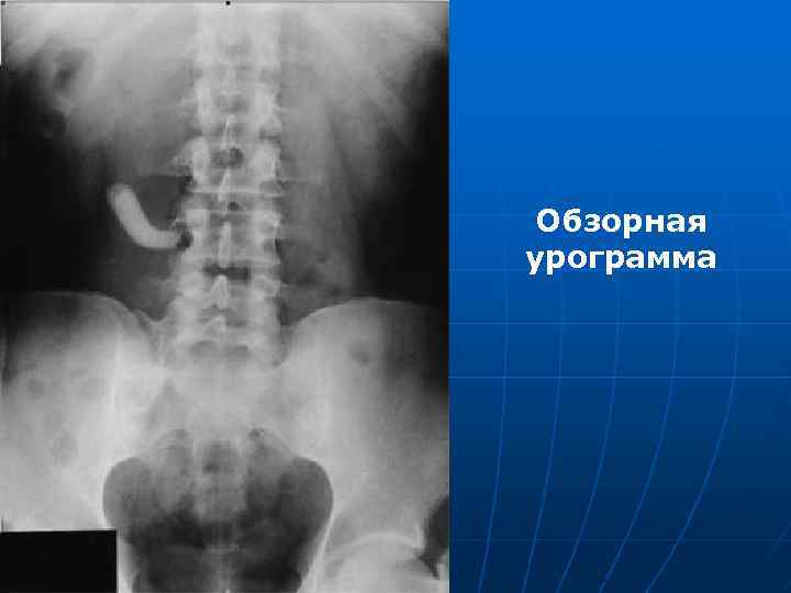 Обзорная урограмма 