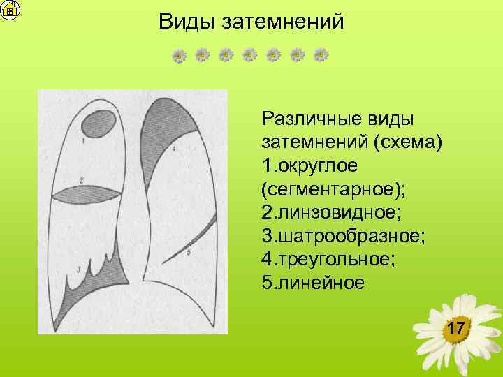 Виды затемнений Различные виды затемнений (схема) 1. округлое (сегментарное); 2. линзовидное; 3. шатрообразное; 4.
