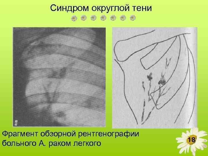 Легкое 18. Срединная тень грудной клетки. Округлая тень в корне легкого на рентгене. Анализ срединной тени на рентгенограмме.