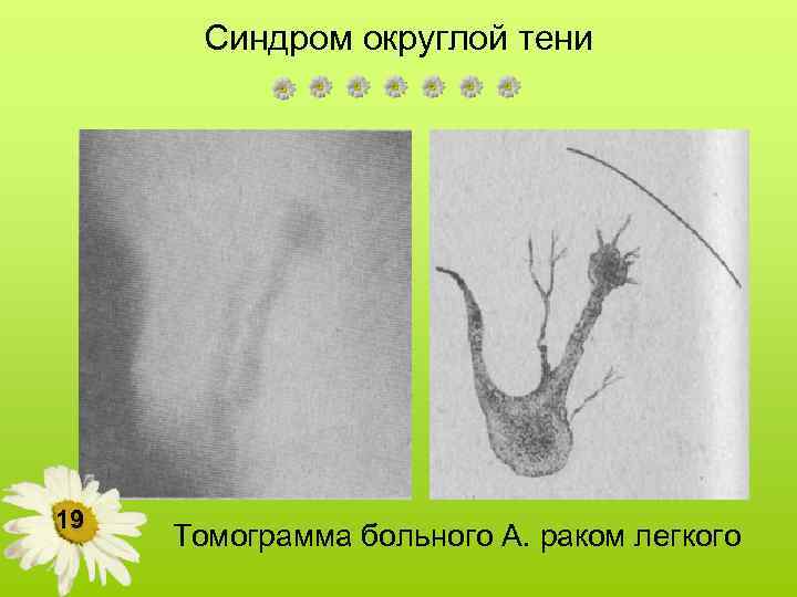 Синдром округлой тени 19 Томограмма больного А. раком легкого 