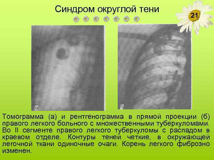 Синдром округлой тени 21 Томограмма (а) и рентгенограмма в прямой проекции (б) правого легкого