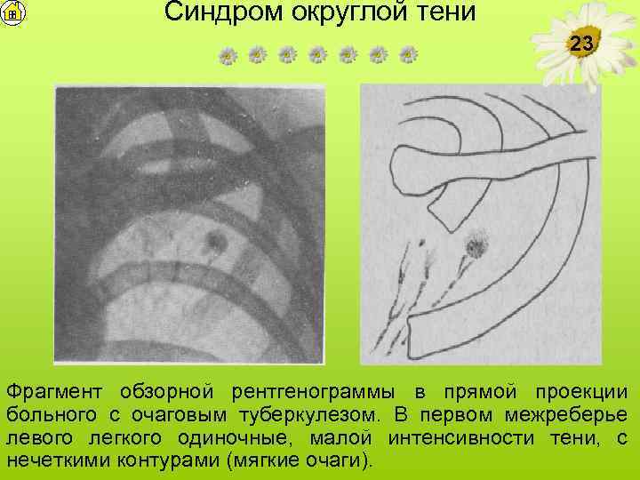 Синдром округлой тени 23 Фрагмент обзорной рентгенограммы в прямой проекции больного с очаговым туберкулезом.