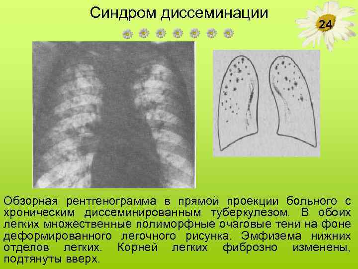 Синдром диссеминации 24 Обзорная рентгенограмма в прямой проекции больного с хроническим диссеминированным туберкулезом. В