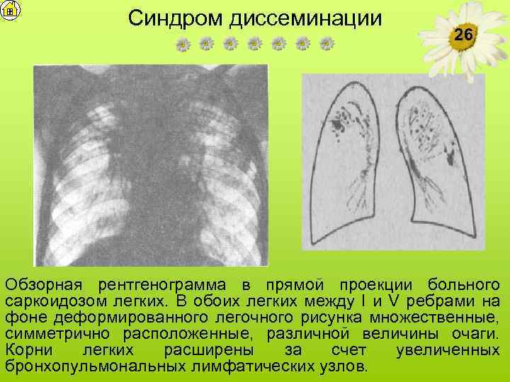 Синдром диссеминации 26 Обзорная рентгенограмма в прямой проекции больного саркоидозом легких. В обоих легких