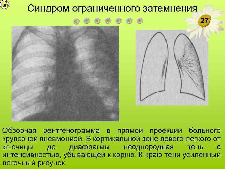 Синдром ограниченного затемнения 27 Обзорная рентгенограмма в прямой проекции больного крупозной пневмонией. В кортикальной