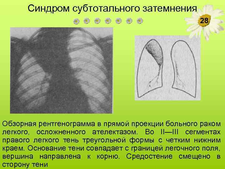 Синдром субтотального затемнения 28 Обзорная рентгенограмма в прямой проекции больного раком легкого, осложненного ателектазом.