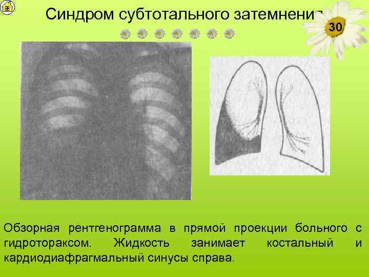 Синдром субтотального затемнения 30 Обзорная рентгенограмма в прямой проекции больного с гидротораксом. Жидкость занимает