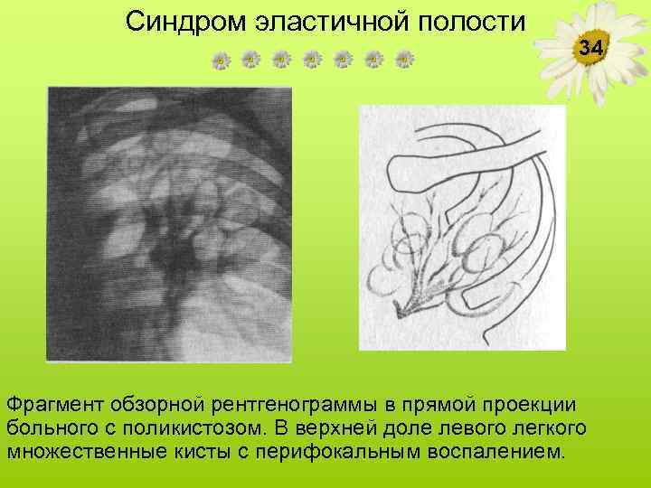 Синдром эластичной полости 34 Фрагмент обзорной рентгенограммы в прямой проекции больного с поликистозом. В