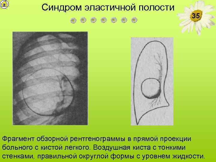 Синдром эластичной полости 35 Фрагмент обзорной рентгенограммы в прямой проекции больного с кистой легкого.