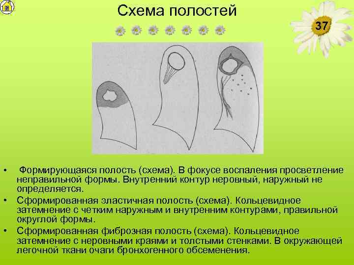 Схема полостей 37 Формирующаяся полость (схема). В фокусе воспаления просветление неправильной формы. Внутренний контур