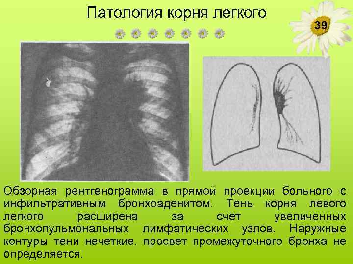 Патология корня легкого 39 Обзорная рентгенограмма в прямой проекции больного с инфильтративным бронхоаденитом. Тень