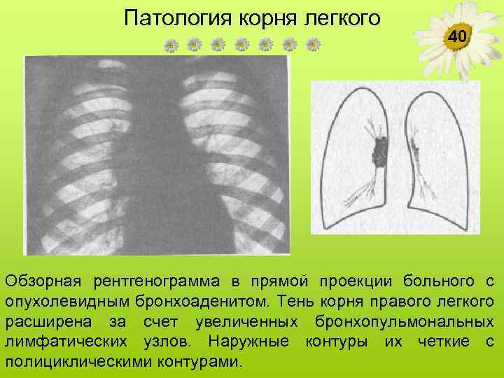 Патология корня легкого 40 Обзорная рентгенограмма в прямой проекции больного с опухолевидным бронхоаденитом. Тень