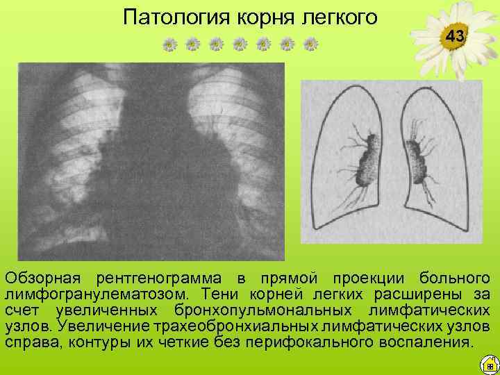 Патология корня легкого 43 Обзорная рентгенограмма в прямой проекции больного лимфогранулематозом. Тени корней легких