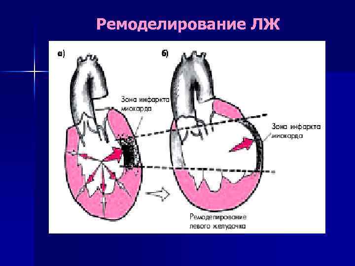 Миокарда левого желудочка. Инфаркт миокарда ремоделирование левого желудочка. Ремоделирование левого желудочка. Стадии ремоделирования миокарда. Механизмы ремоделирования миокарда.