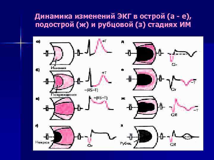 Динамика изменений ЭКГ в острой (а - е), подострой (ж) и рубцовой (з) стадиях