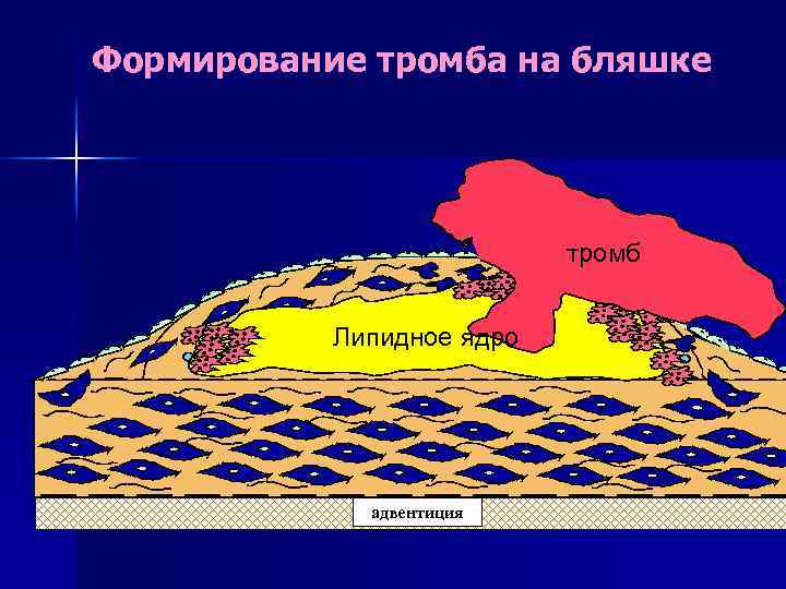 Формирование тромба на бляшке тромб lipid core Липидное ядро адвентиция 