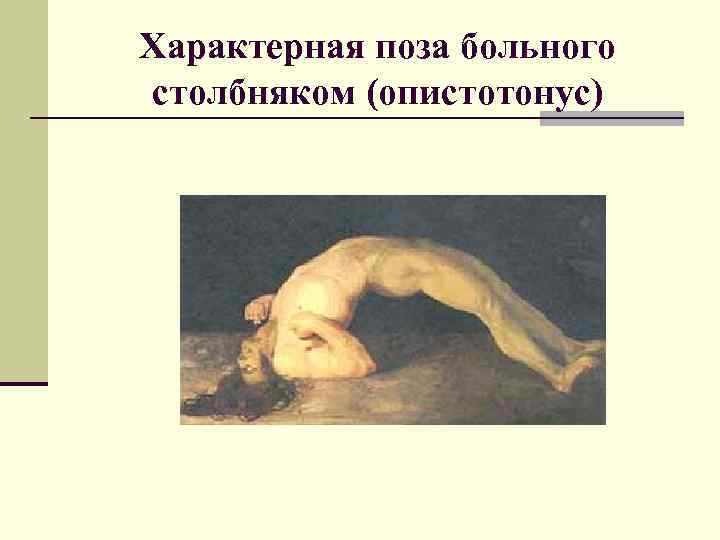 Характерная поза больного столбняком (опистотонус) 