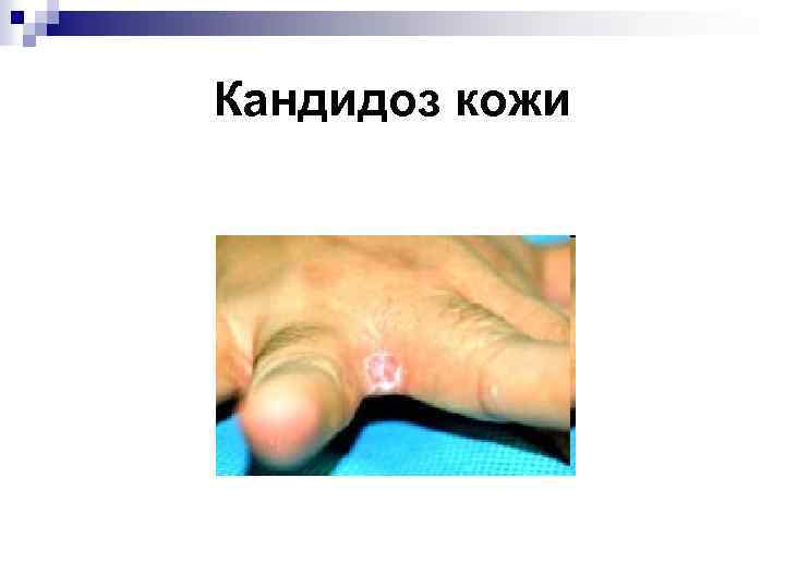 Кандидоз кожи 