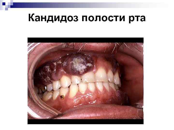 Кандидоз полости рта 