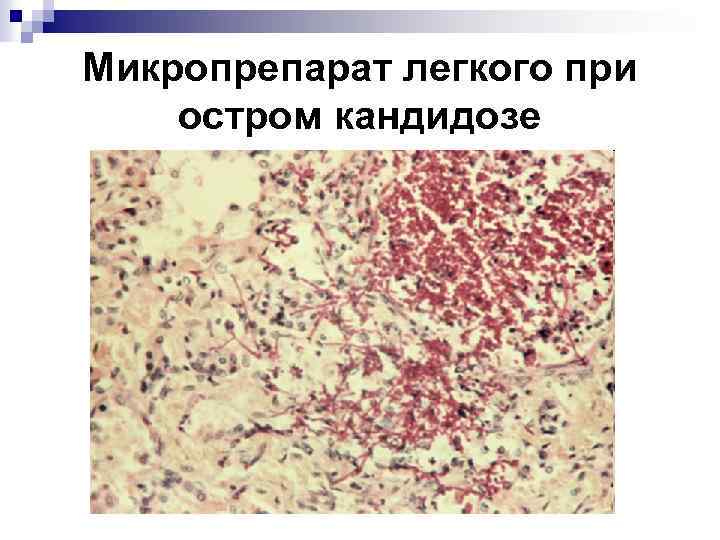 Микропрепарат легкого при остром кандидозе 