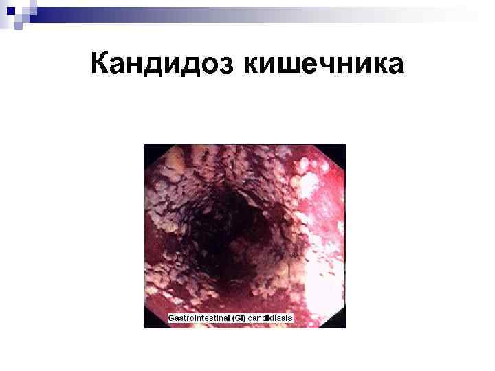 Кандидоз кишечника 