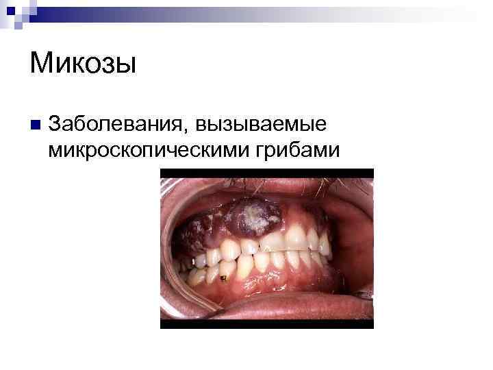 Микозы n Заболевания, вызываемые микроскопическими грибами 