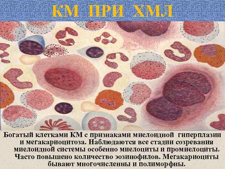 КМ ПРИ ХМЛ Богатый клетками КМ с признаками миелоидной гиперплазии и мегакариоцитоза. Наблюдаются все