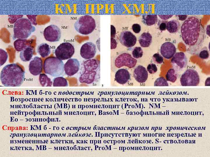 КМ ПРИ ХМЛ Слева: КМ б-го с подострым гранулоцитарным лейкозом. Возросшее количество незрелых клеток,