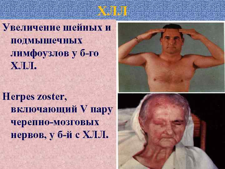 ХЛЛ Увеличение шейных и подмышечных лимфоузлов у б-го ХЛЛ. Herpes zoster, включающий V пару
