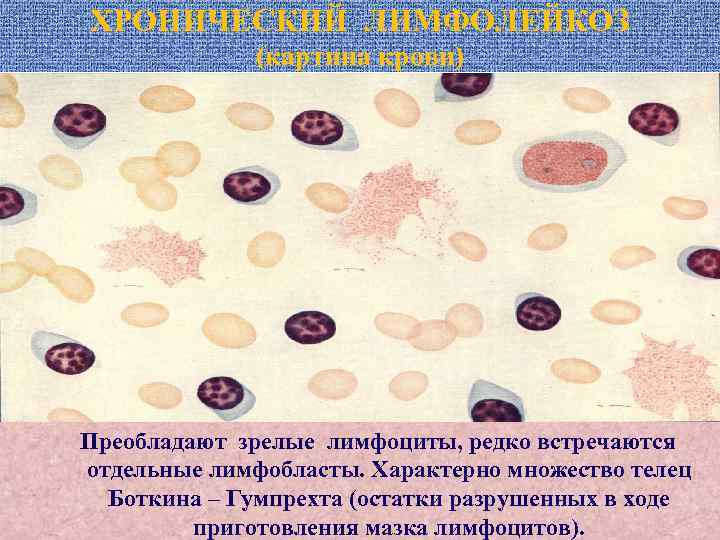 ХРОНИЧЕСКИЙ ЛИМФОЛЕЙКОЗ (картина крови) Преобладают зрелые лимфоциты, редко встречаются отдельные лимфобласты. Характерно множество телец