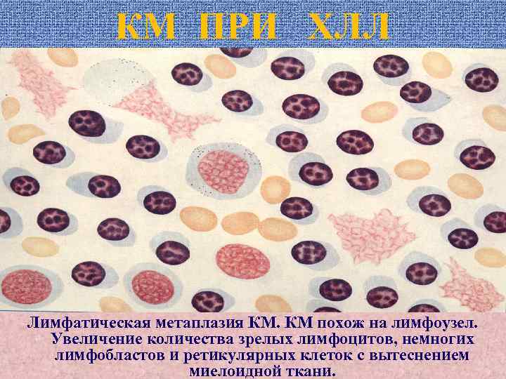 КМ ПРИ ХЛЛ Лимфатическая метаплазия КМ. КМ похож на лимфоузел. Увеличение количества зрелых лимфоцитов,