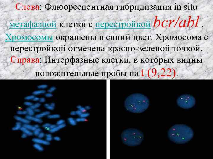 Слева: Флюоресцентная гибридизация in situ bcr/abl метафазной клетки с перестройкой. Хромосомы окрашены в синий